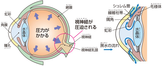 緑内障