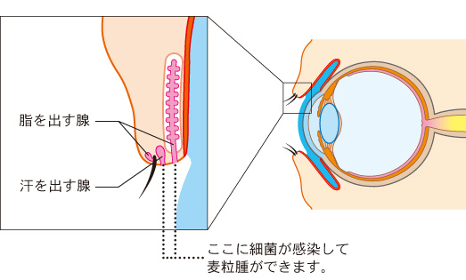 ものもらい（麦粒腫）