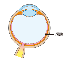 糖尿病網膜症